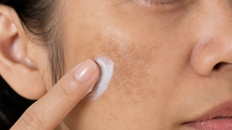 Leke Kremi İşe Yarar mı? Dermatolog Gözüyle