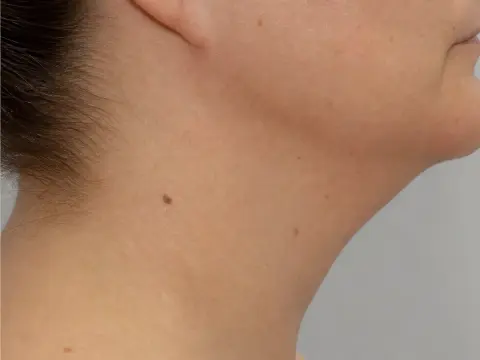 Gıdı Liposuction: Çene Altı Yağına Kalıcı Cerrahi Çözüm