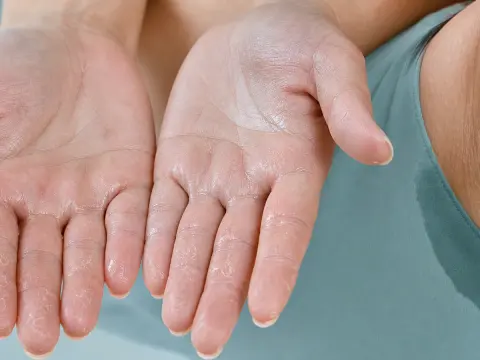 Aşırı Terleme (Hiperhidroz) Tedavisi: Terleme Botoksu